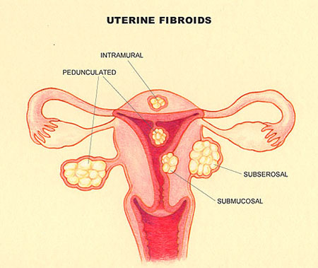 fibroids